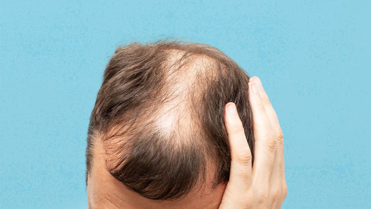 Les avantages de Propecia Finasteride 1mg pour prévenir la perte de cheveux chez les hommes